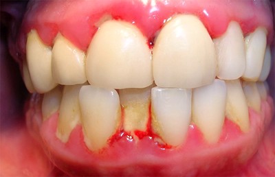 Viêm quanh cuống răng là bệnh gì? XEM NGAY